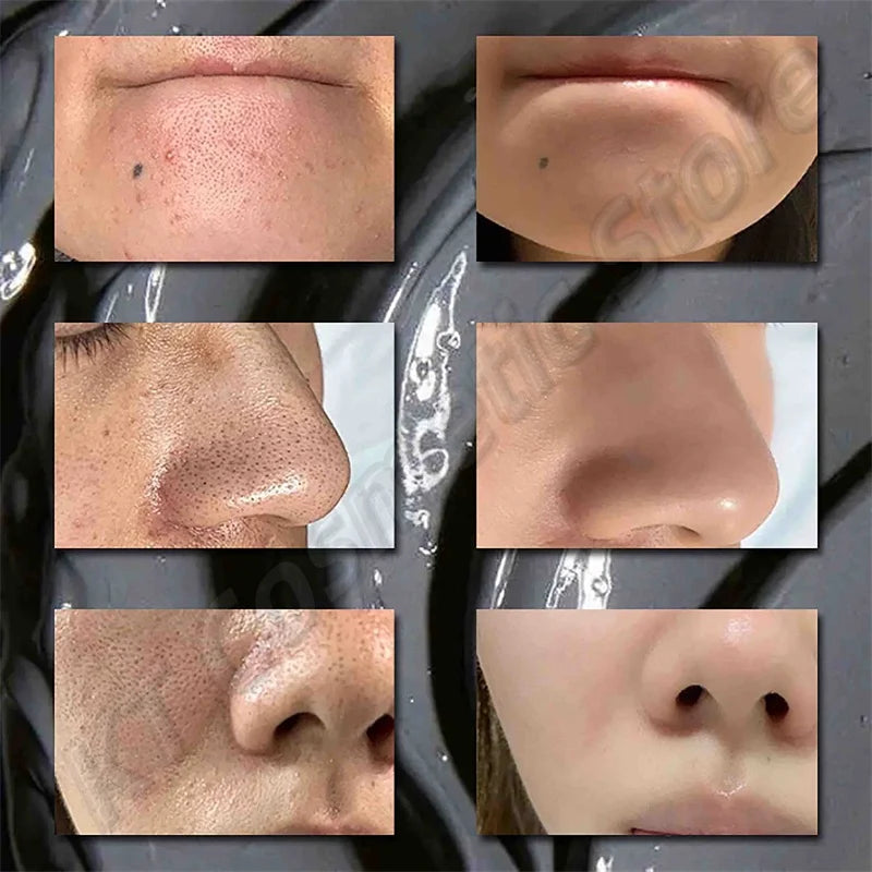 Before and after results showing skin texture improvement using Dead Sea Mud Face Mask Deep Cleaning Pores Remove Blackheads Oil Control Moisturizing Brighten Smooth Skin Care Beauty Products.
