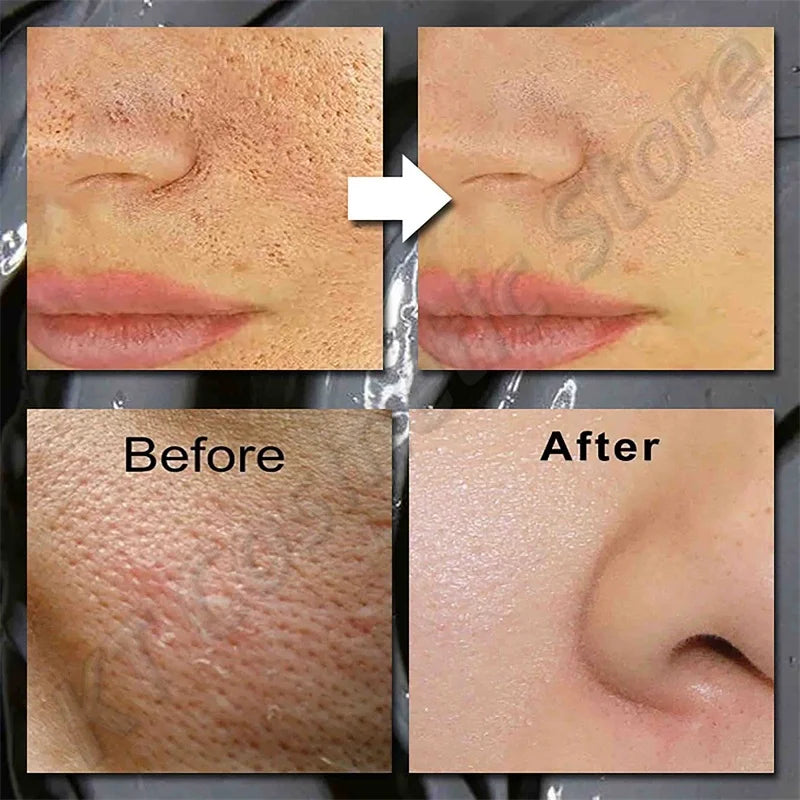 Before and after results showing skin texture improvement using Dead Sea Mud Face Mask Deep Cleaning Pores Remove Blackheads Oil Control Moisturizing Brighten Smooth Skin Care Beauty Products.